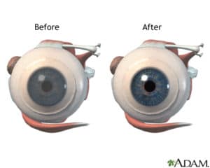 Optometrist In Grand Forks Nd Advanced Eyecare Optometrist In Grand Forks Nd Advanced Eyecare