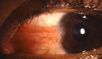 Pterygium_small