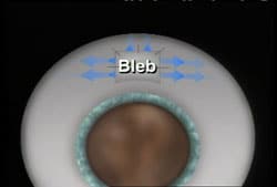 <h6><span>A small channel, or <br>‘bleb’ is created to <br>allow fluid to drain from the eye. (See <br>animation below.)</span></h6>
