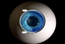 Pre-existing astigmatism can be treated with limbal relaxing incisions or the LenSx Femtosecond Laser..