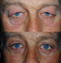 <h6><span>Figure 1: Before (Top) <br>&amp; After Blepharoplasty</span></h6>