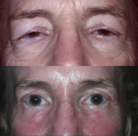 <h6><span>Figure 2: Before (Top)<br> &amp; After Ptosis Repair</span></h6>